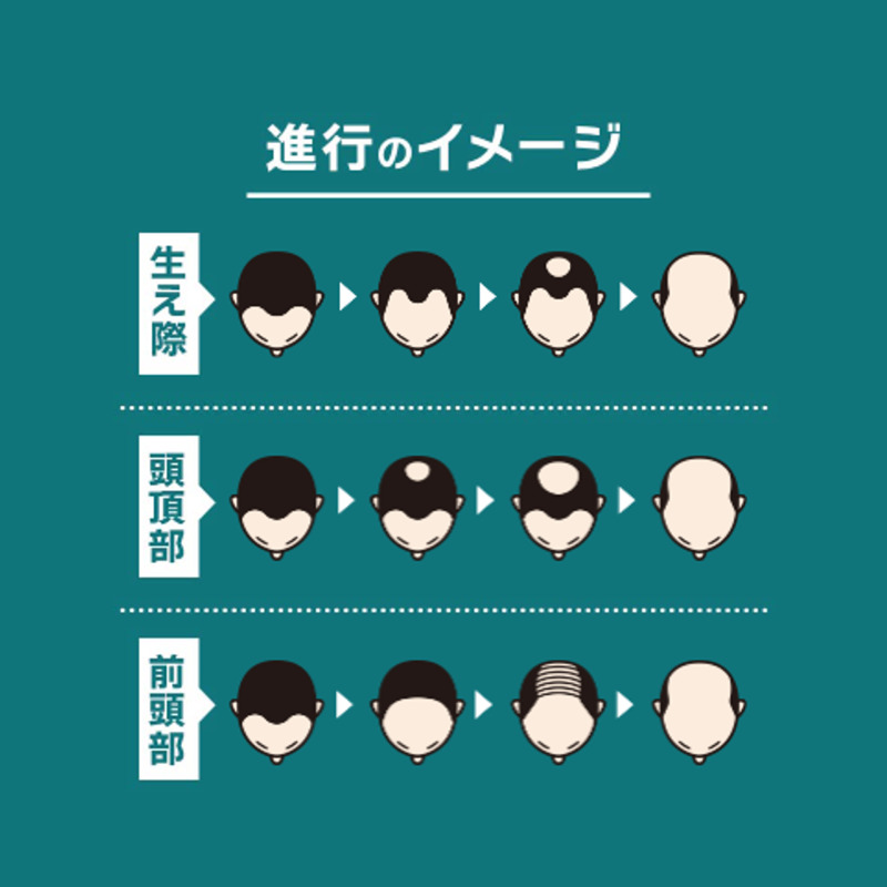 【AGA（薄毛）治療】東京青山クリニックの口コミや評判を徹底調査！AGAの進行イメージ
