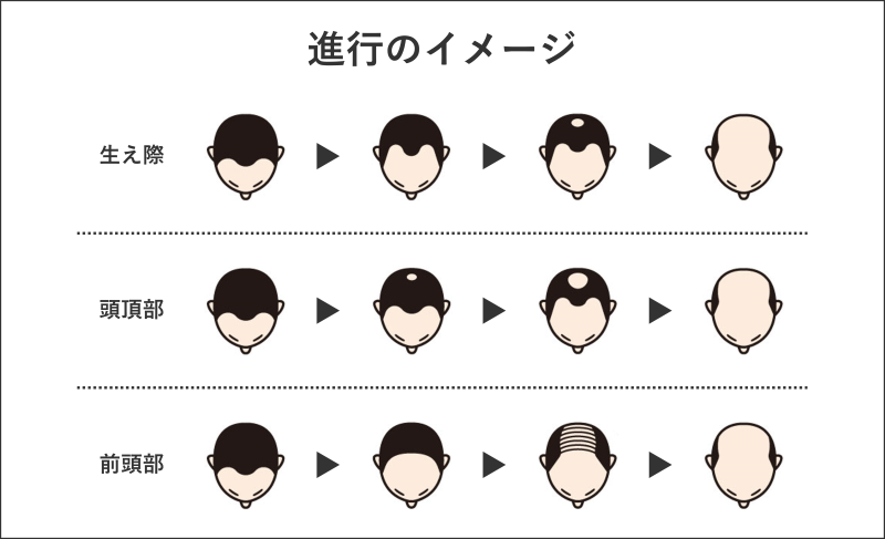 東京駅周辺のAGA治療（薄毛治療）ができるクリニックおすすめ3選！AGAの進行イメージ
